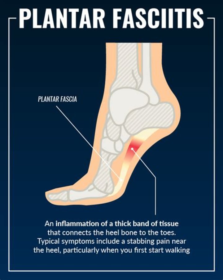 What is the cause of plantar fasciitis